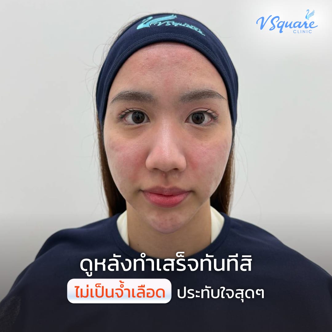 รีวิว Pico Laser หลังทำ