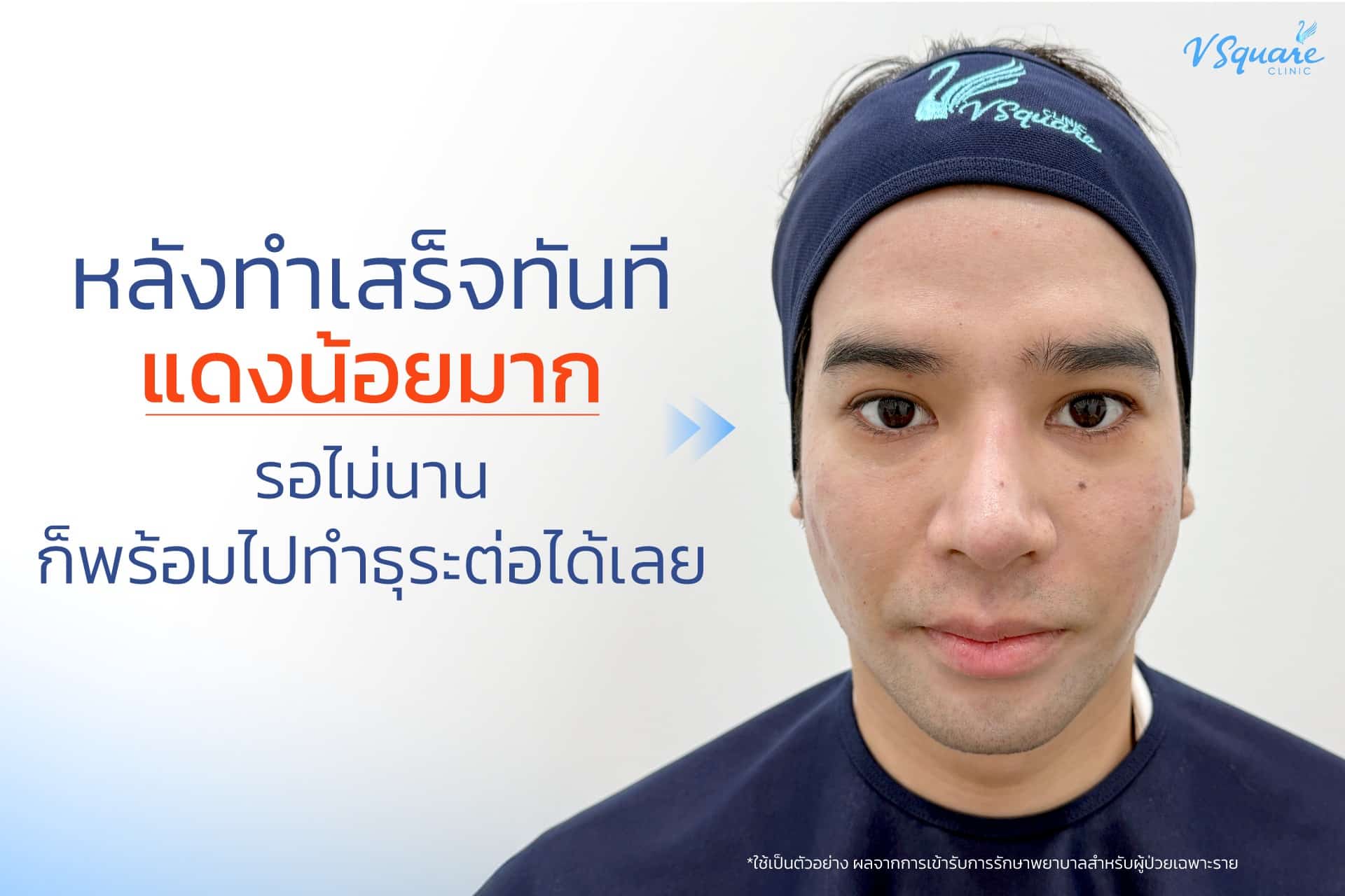 รีวิว Pico Laser หลังทำ