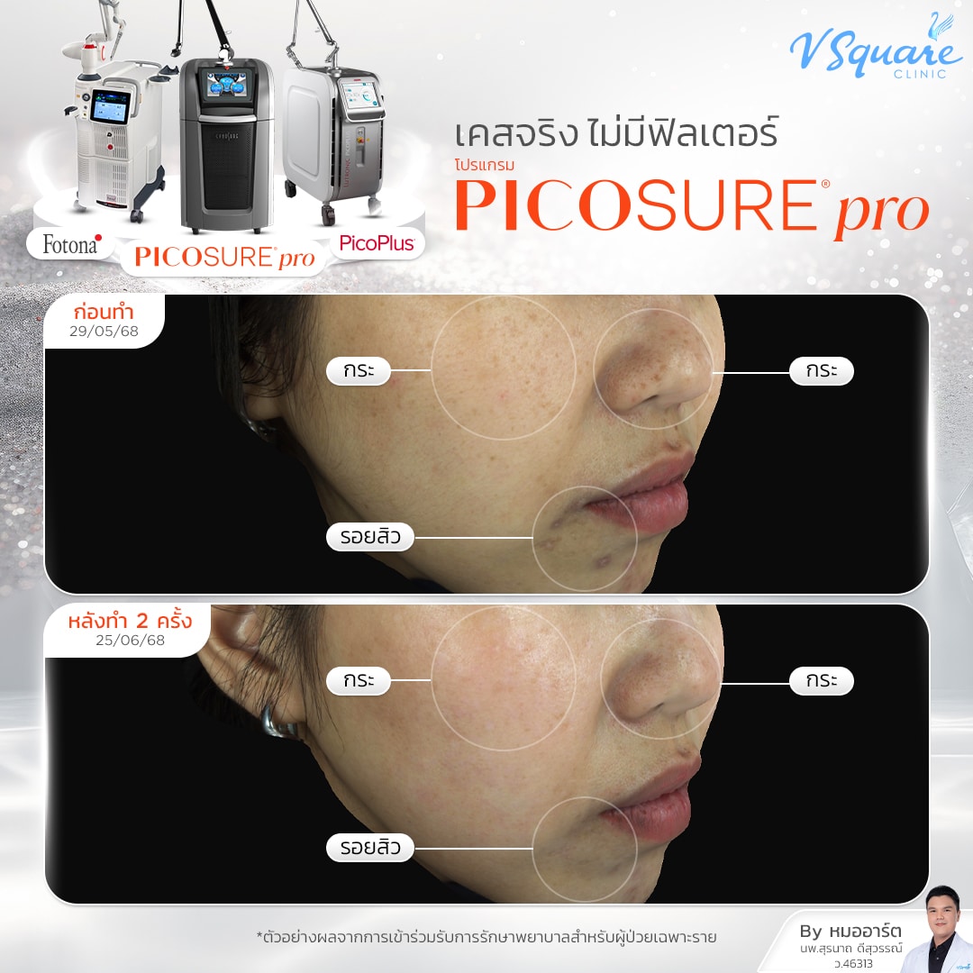 รีวิว Picosure Pro_คุณนัน
