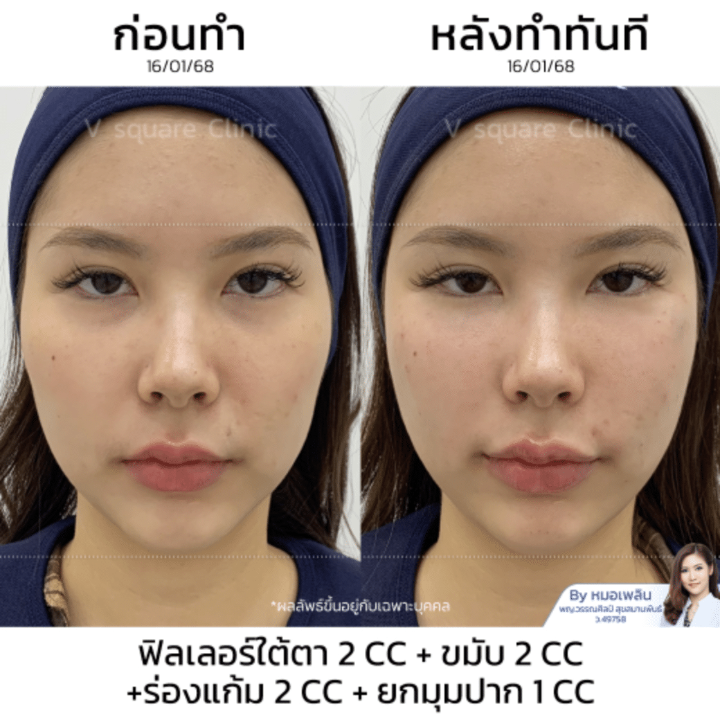 รีวิวยกมุมปาก_คุณเฟิร์น Influencer