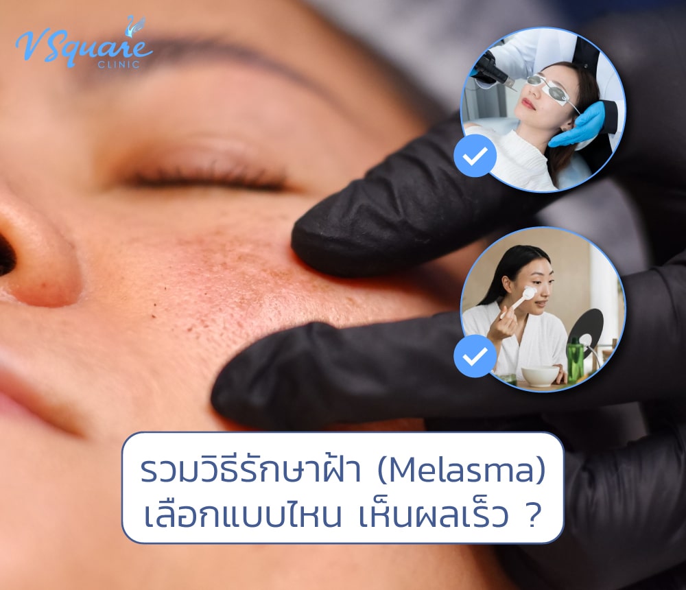 วิธีรักษาฝ้า