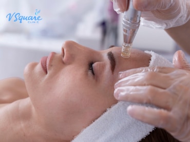 เทคโนโลยี Microneedling 370x277