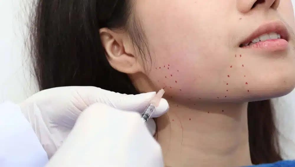 ฉีดโบท็อกลดกราม แก้หน้าเหลี่ยม