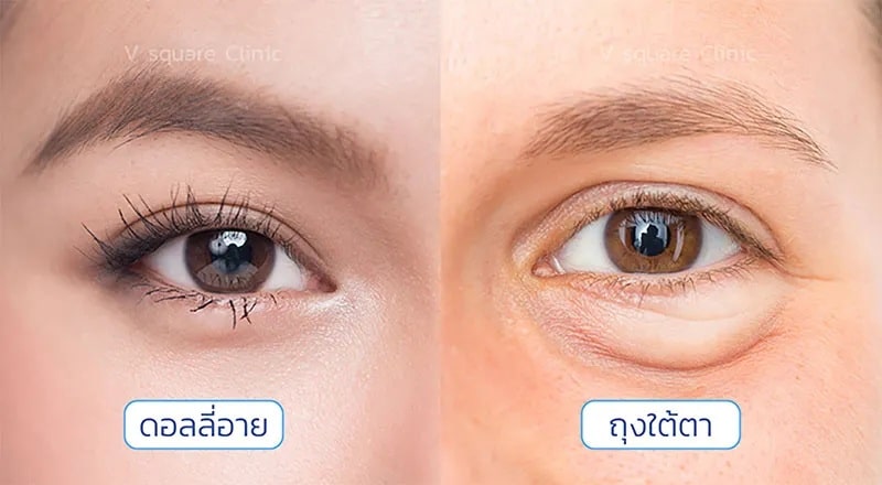 ดอลลี่อาย vs ถุงใต้ตา