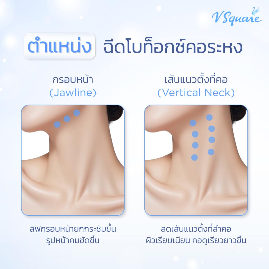 ตำแหน่งฉีดโบท็อกคอระหง