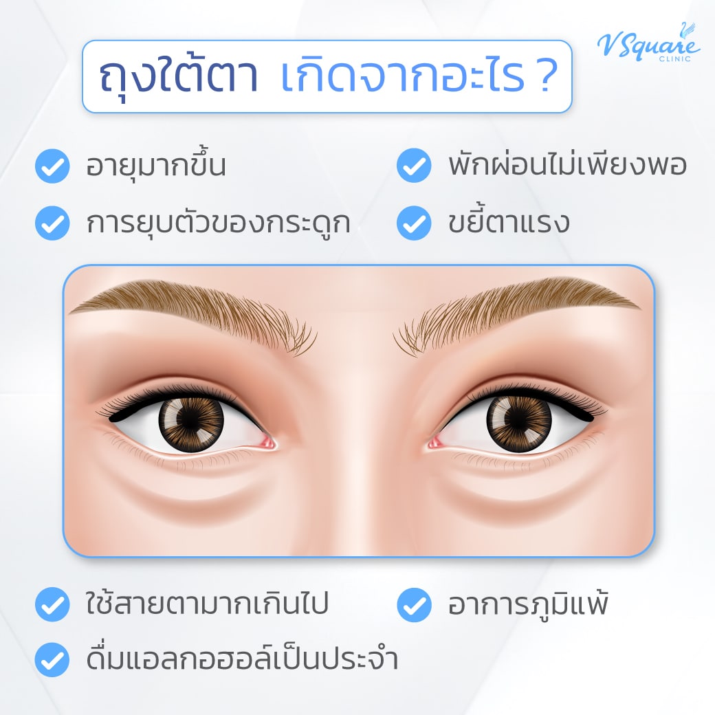 ถุงใต้ตาเกิดจากอะไร