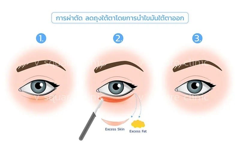 ผ่าตัดรักษาถุงใต้ตาบวม