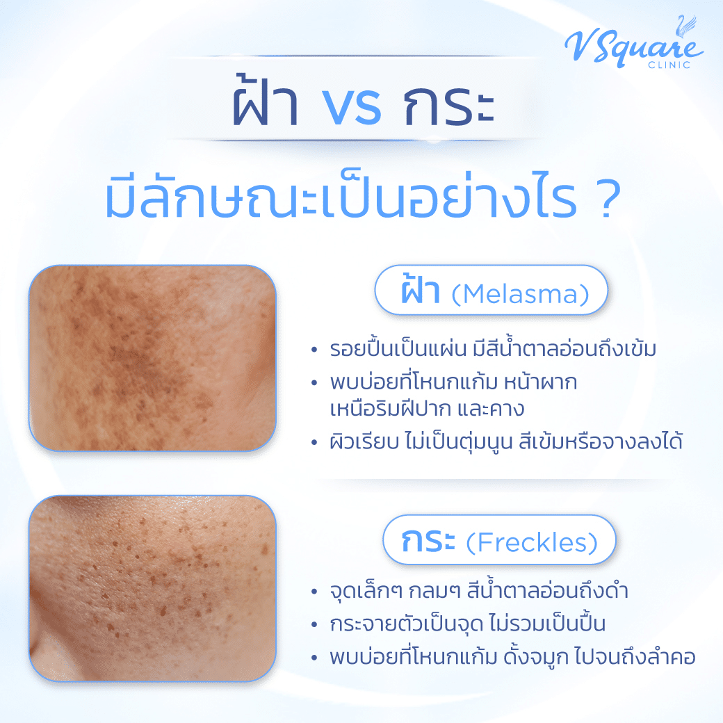 ฝ้า กระ ต่างกันอย่างไร