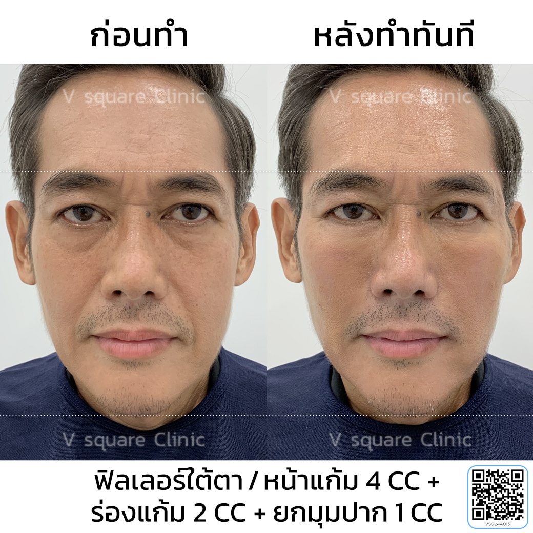 ฟิลเลอร์ยกมุมปาก รีวิว_คุณเจค _มาจากบริษัทยา