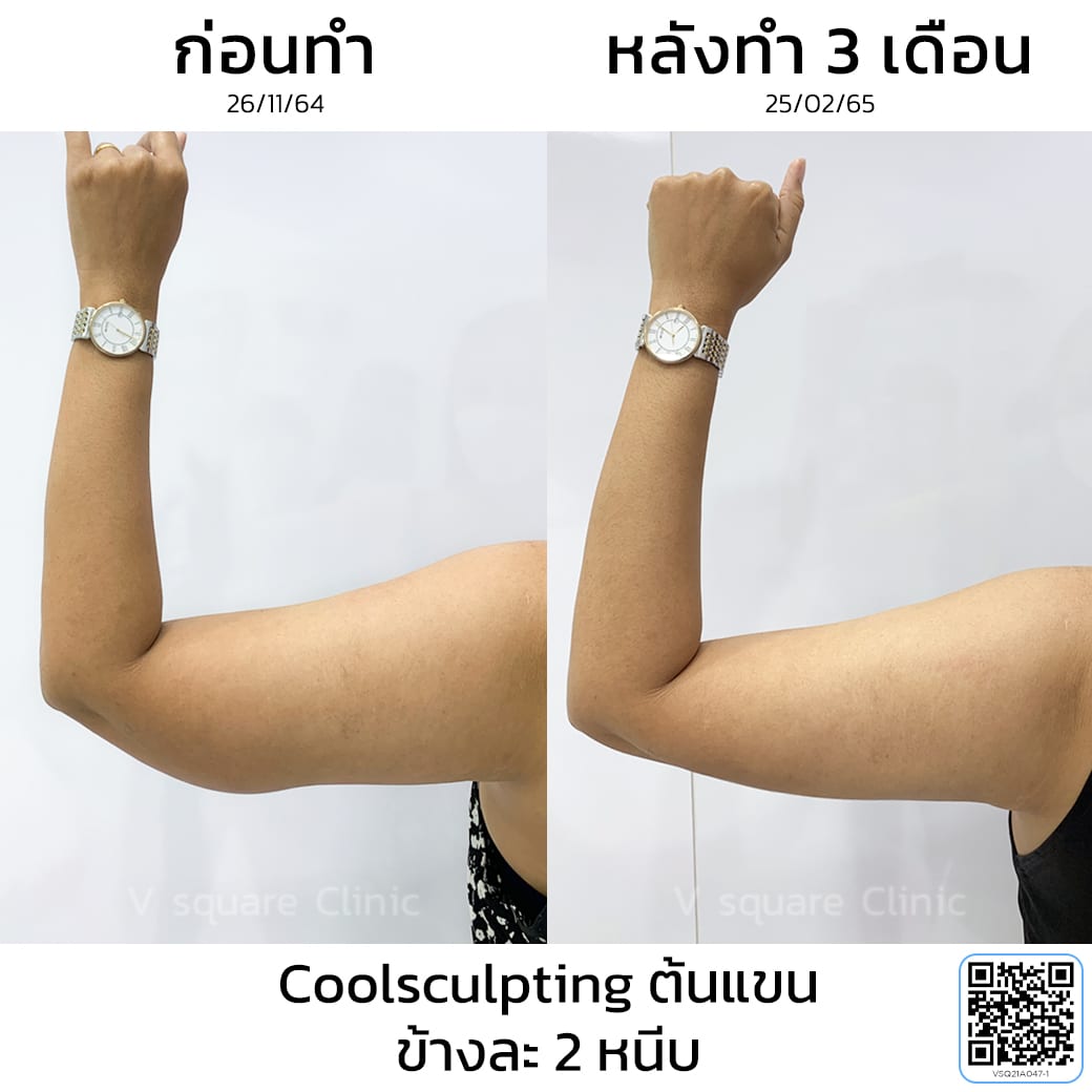 รีวิว Coolsculpting สลายไขมันต้นแขน