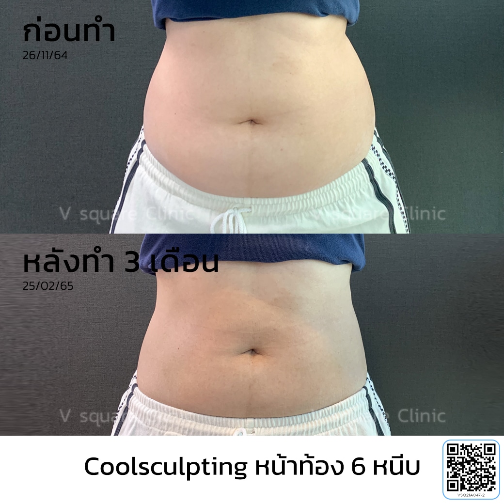 รีวิว Coolsculpting สลายไขมันหน้าท้อง