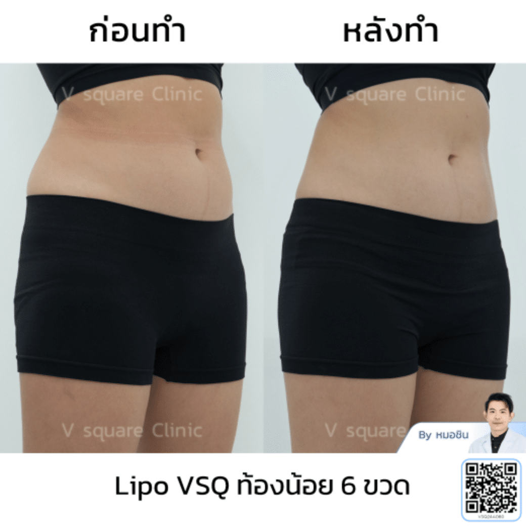 รีวิวฉีดแฟต Lipo VSQ_คุณฟ้า