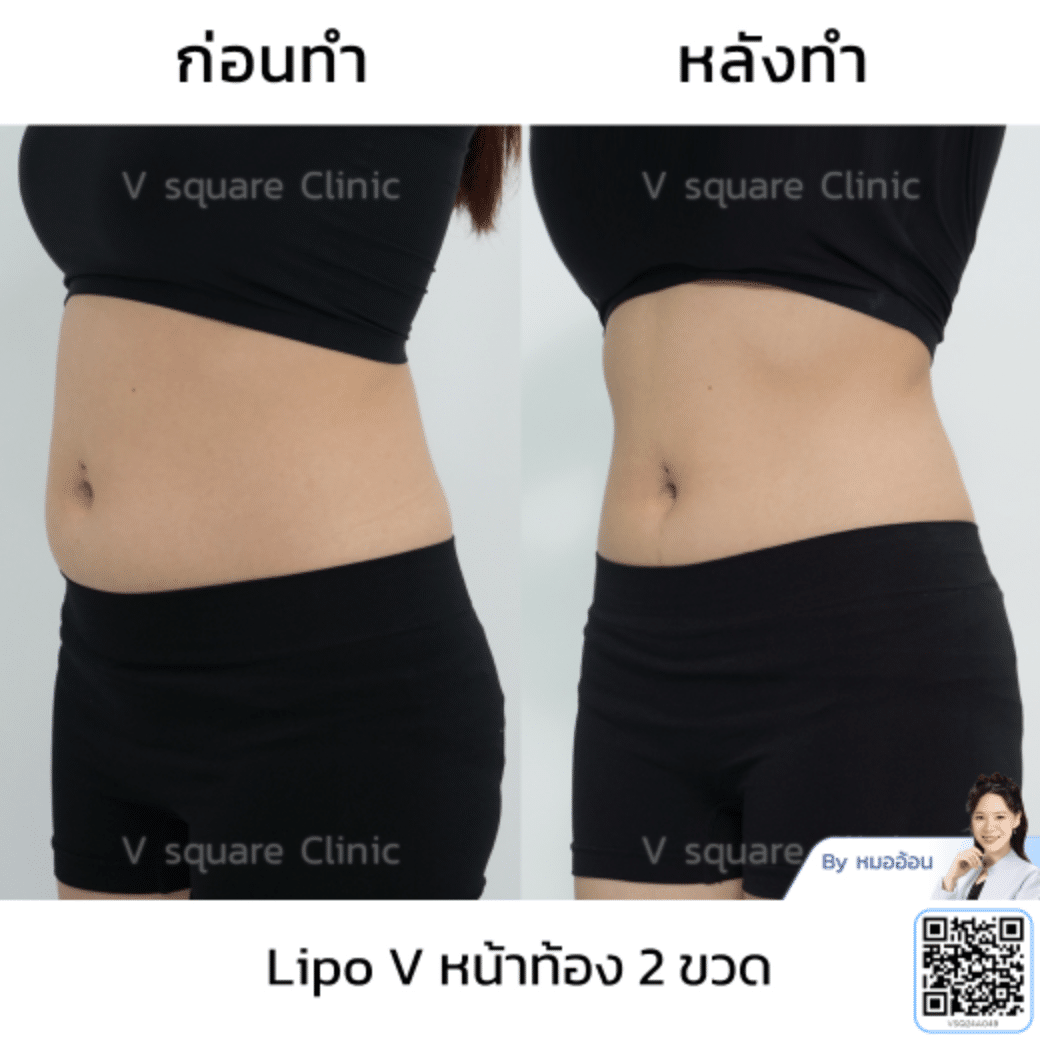 รีวิวฉีดแฟต Lipo VSQ_คุณแคท