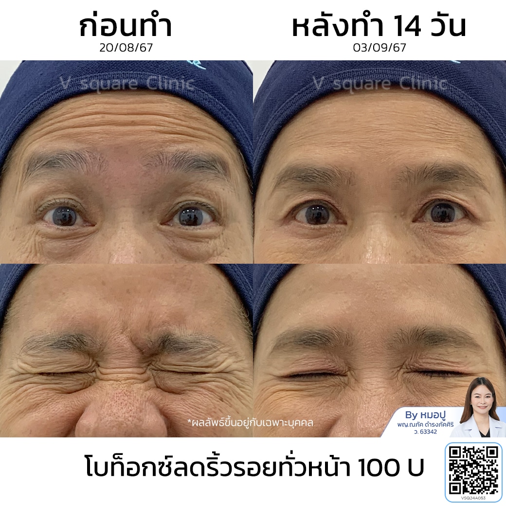 รีวิวฉีดโบท็อกริ้วรอย_คุณชมพู่