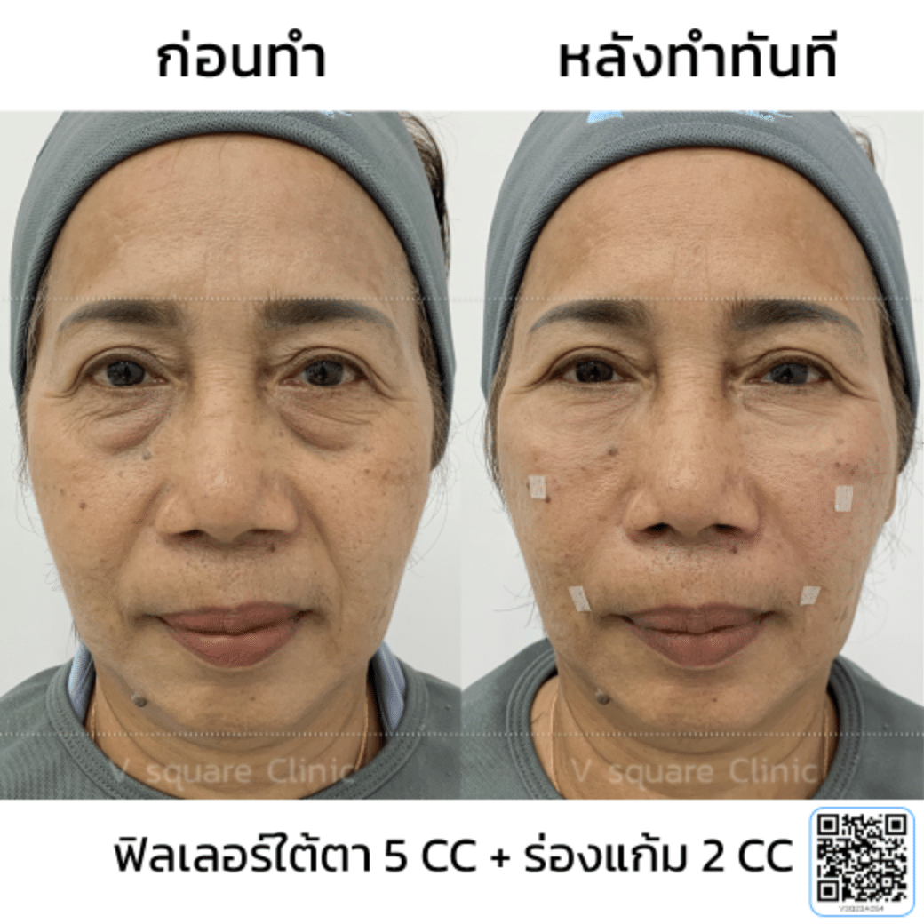 รีวิวฟิลเลอร์ถุงใต้ตา_แม่รุ่ง