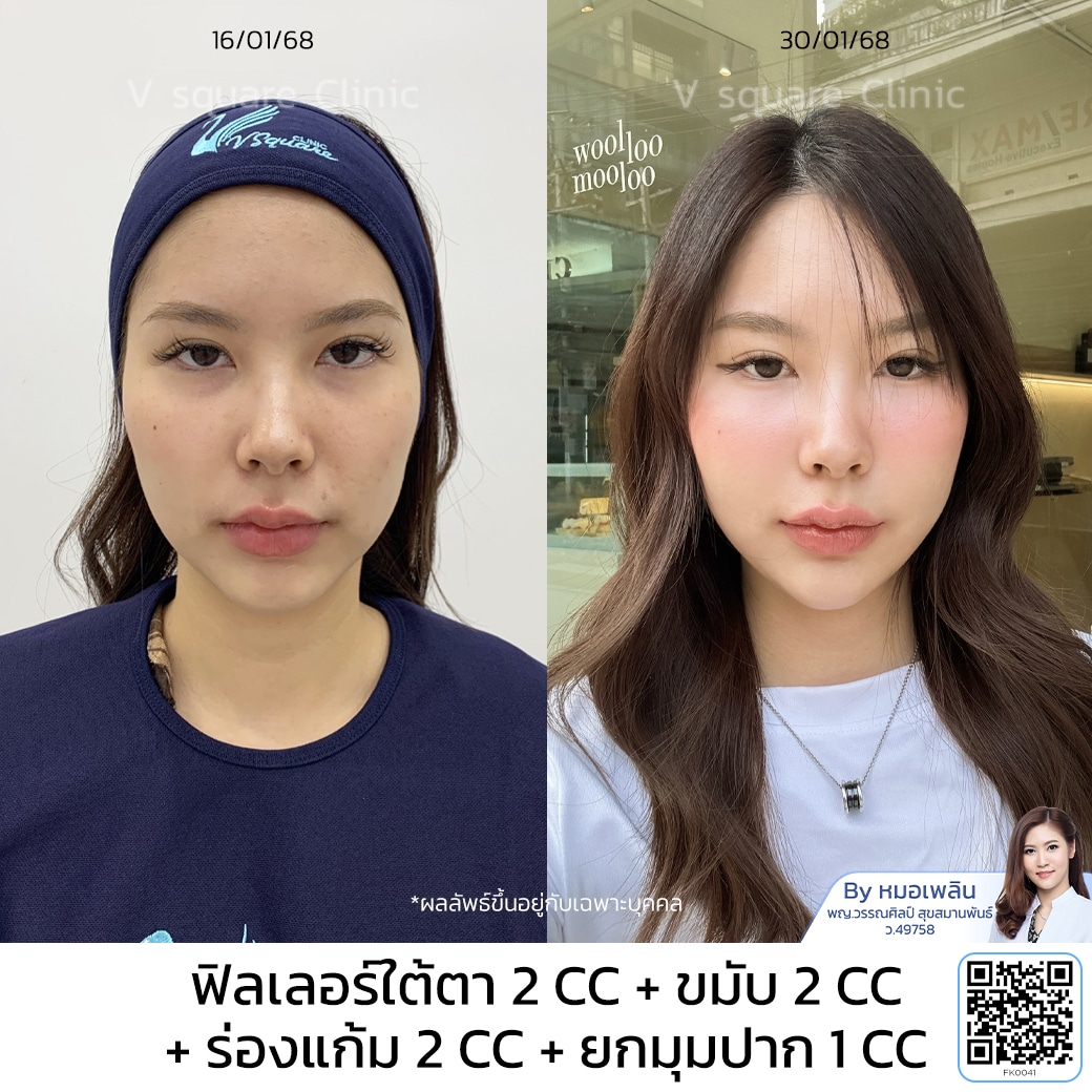 รีวิวฟิลเลอร์ยกมุมปาก_เฟิร์น