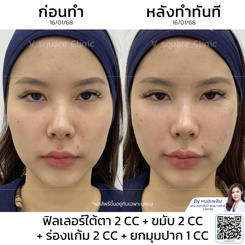 รีวิวยกมุมปาก_คุณเฟิร์น Influencer
