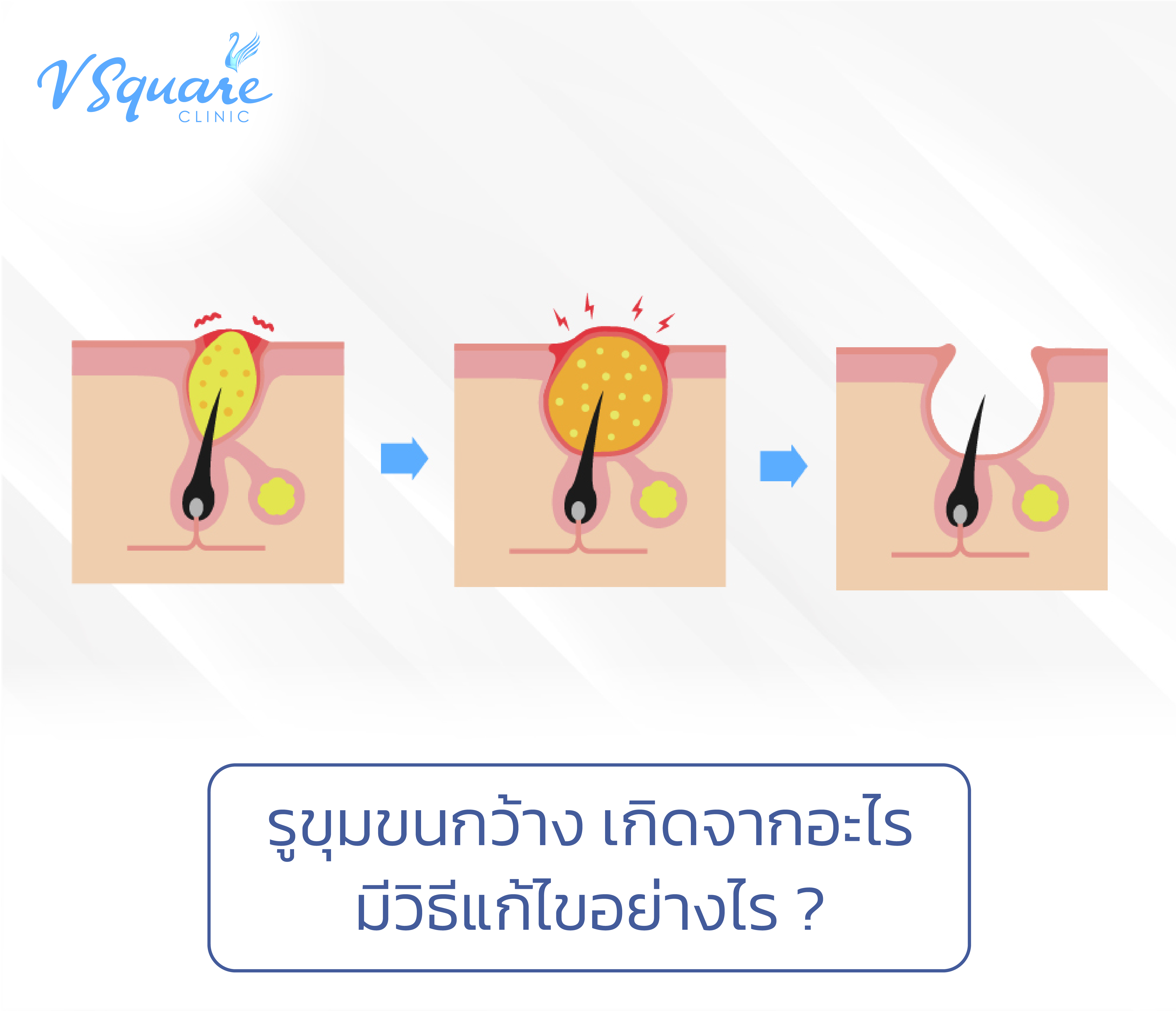 รูขุมขนกว้าง