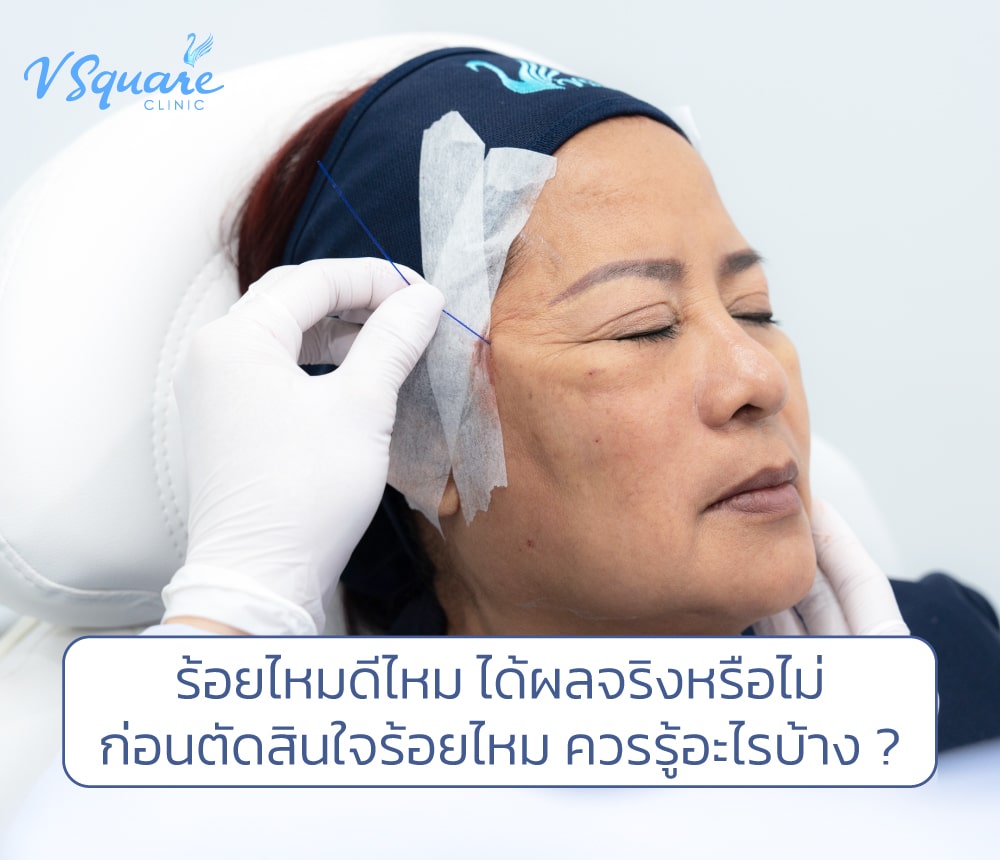 ร้อยไหม ดีไหม