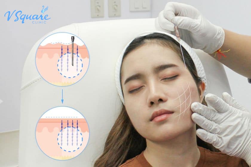 ร้อยไหมดีไหม