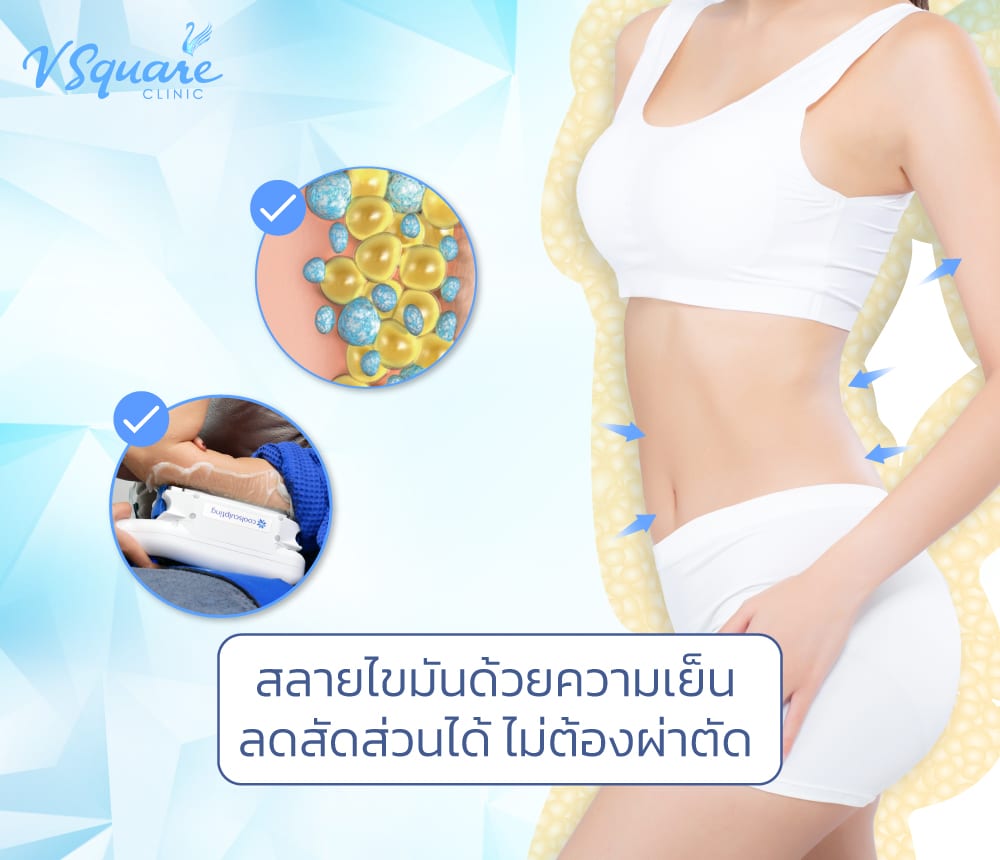 สลายไขมันด้วยความเย็น