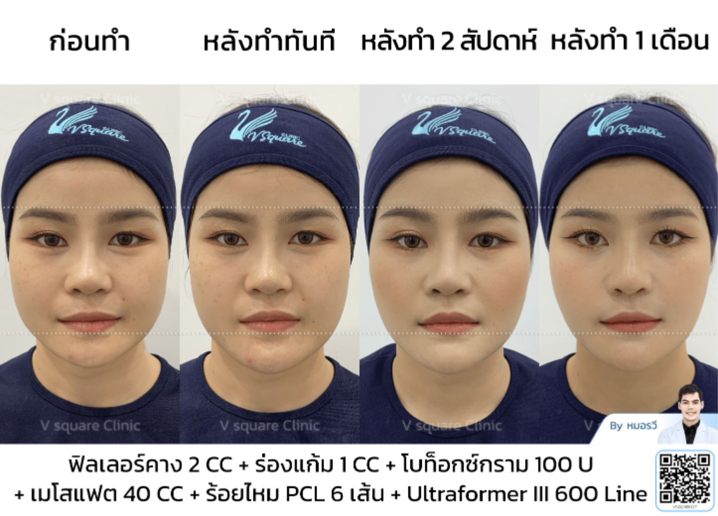 เคสหน้าเรียว_คุณหญิง Influ