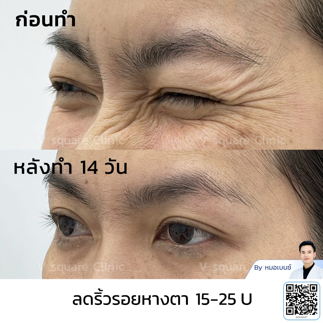 โบท็อกริ้วรอย รีวิว_คุณจุฑามาศ