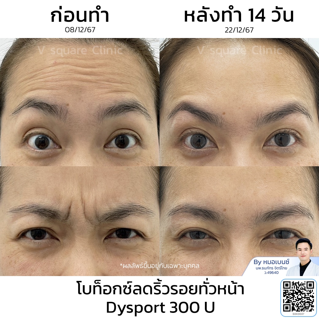 โบท็อกริ้วรอย รีวิว_คุณจุฑามาศ(1)