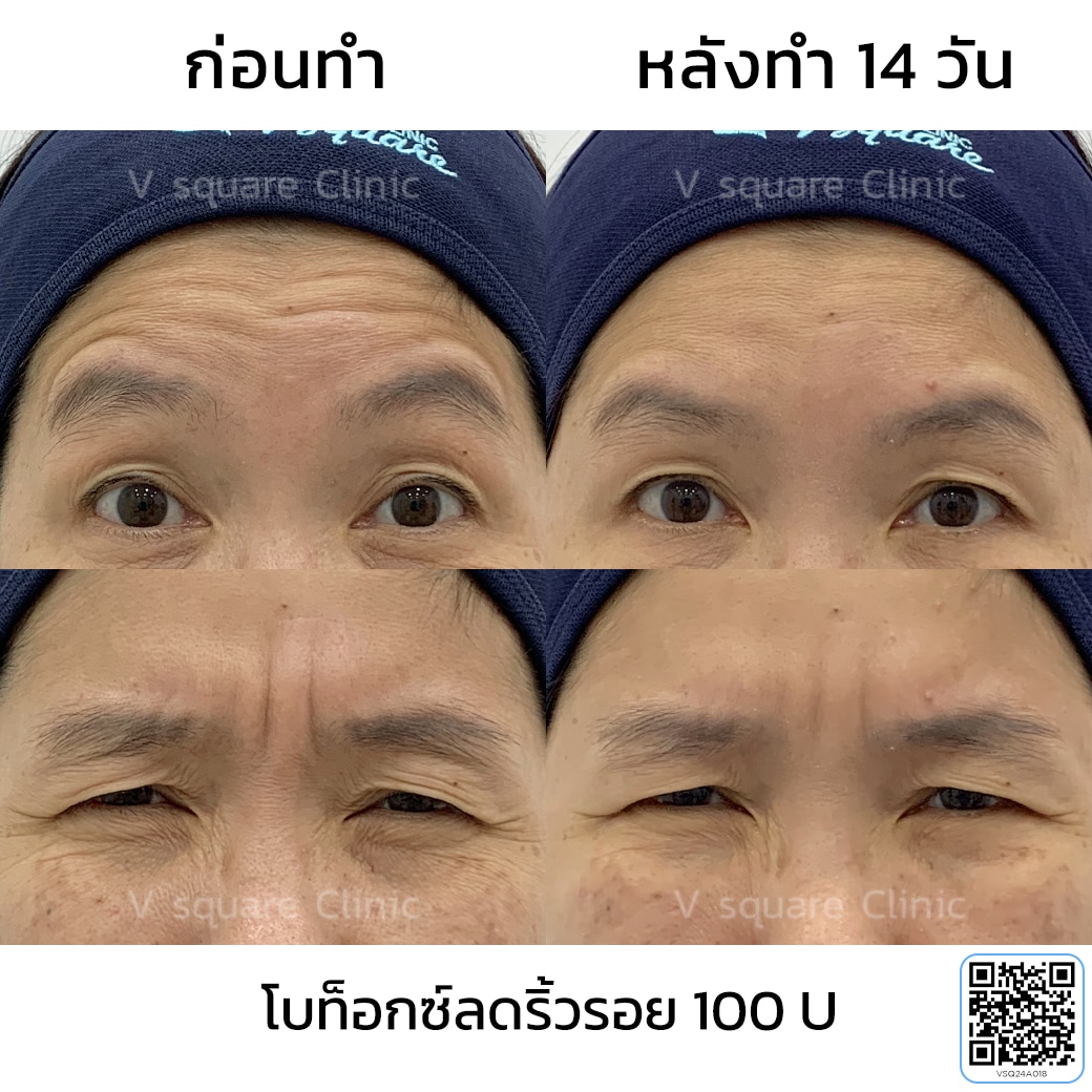 โบท็อกริ้วรอย รีวิว_แม่อ้อย