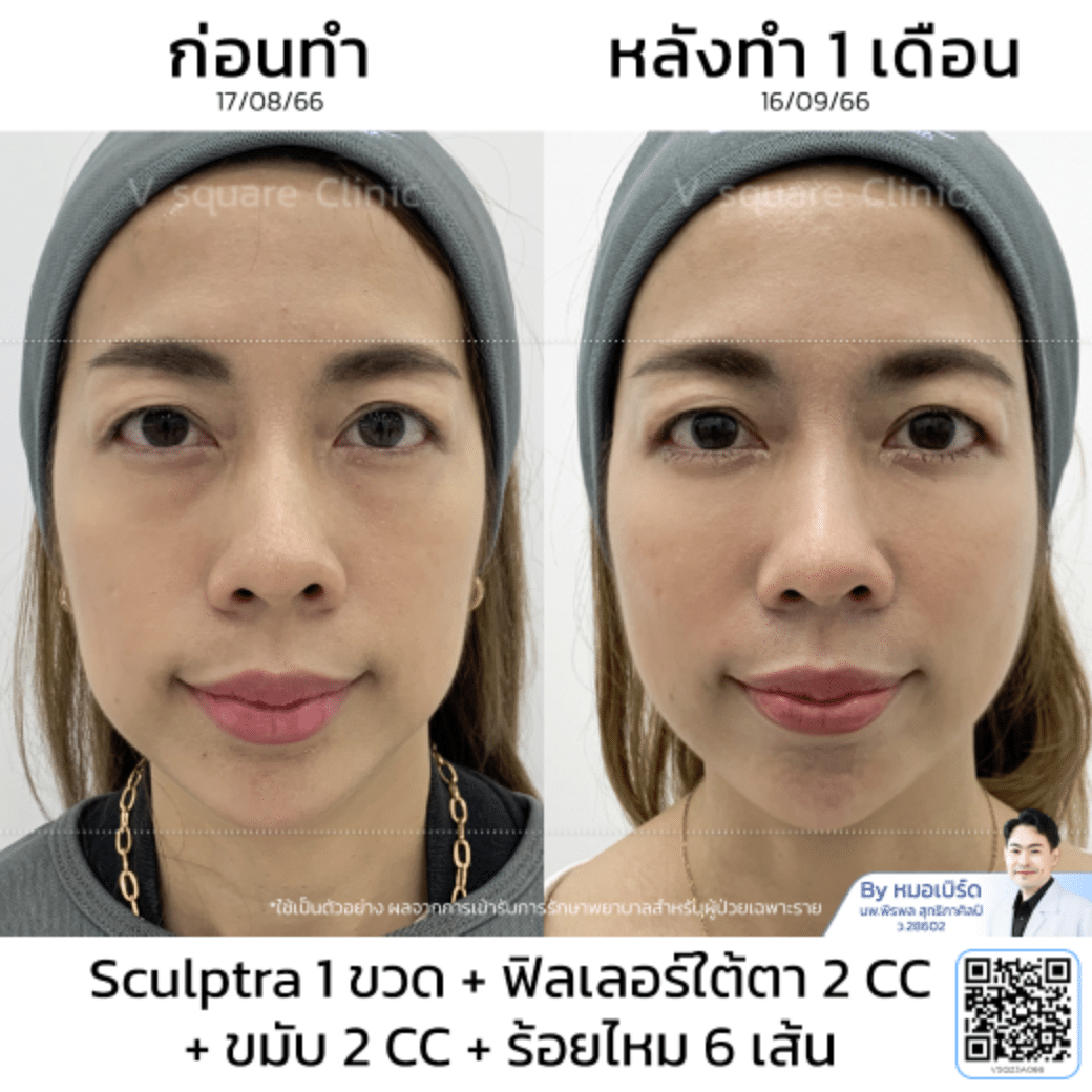 Sculptra รีวิว_คุณเกรซ โดย หมอเบิร์ด