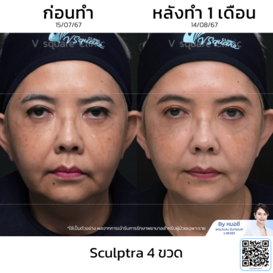 Sculptra รีวิว_พี่ยุ้ย โดย หมอซี