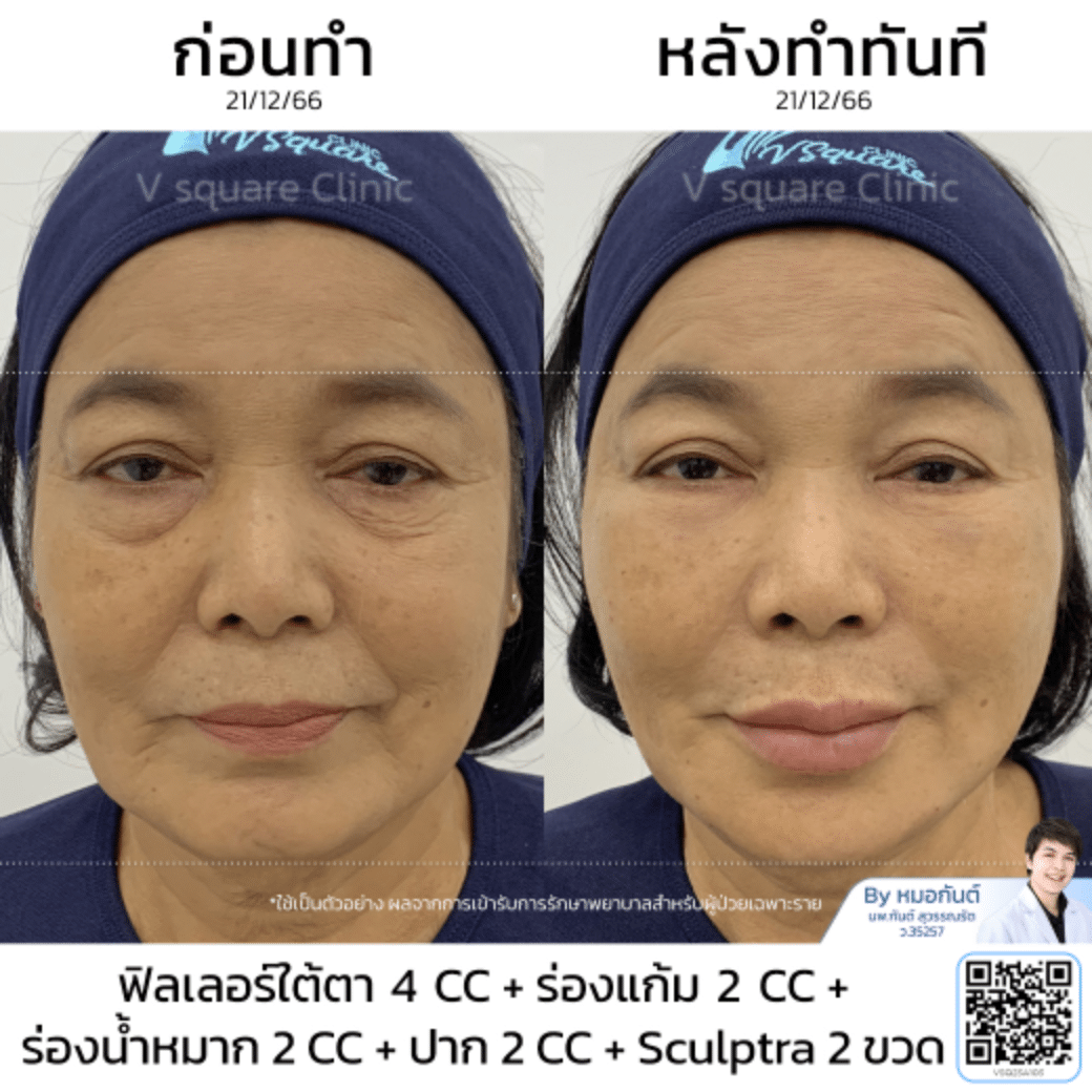 Sculptra รีวิว_แม่แรม โดย หมอ กันต์