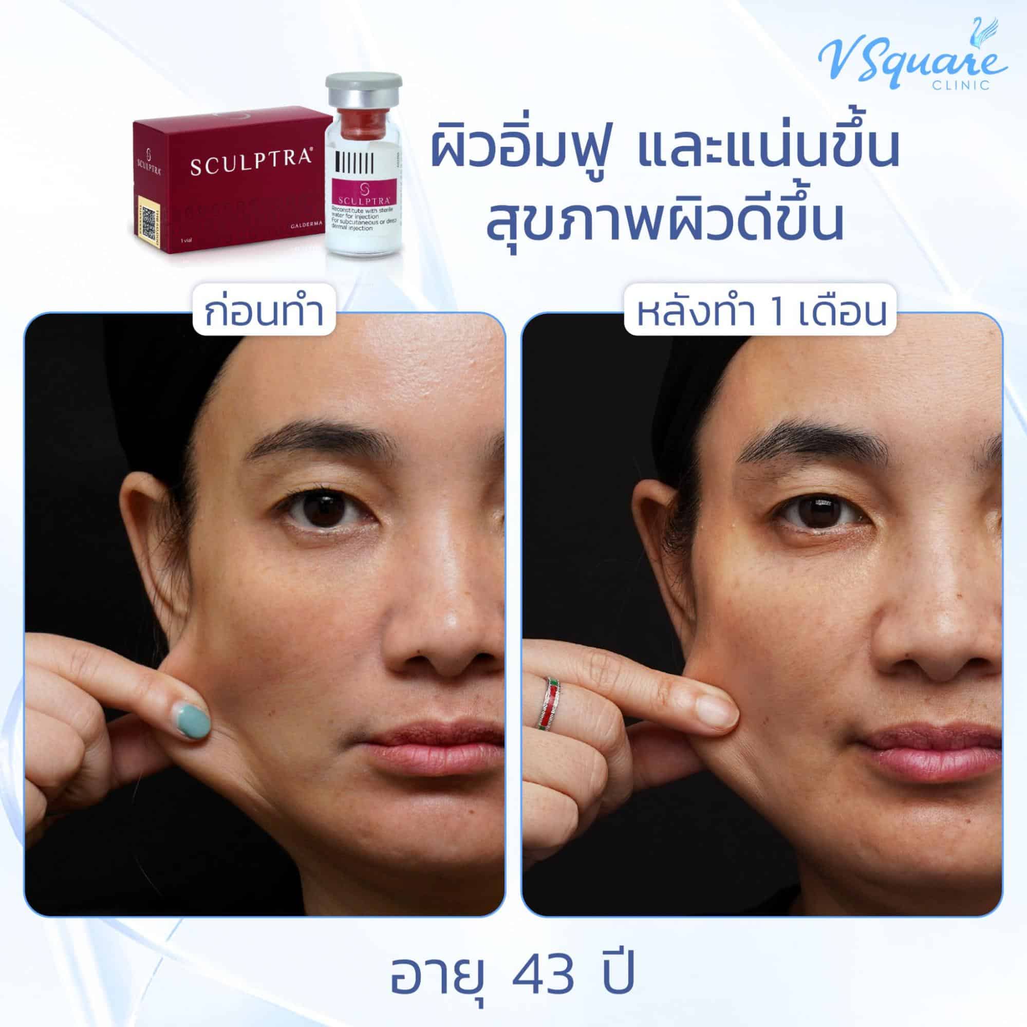 รีวิวฉีด Sculptra