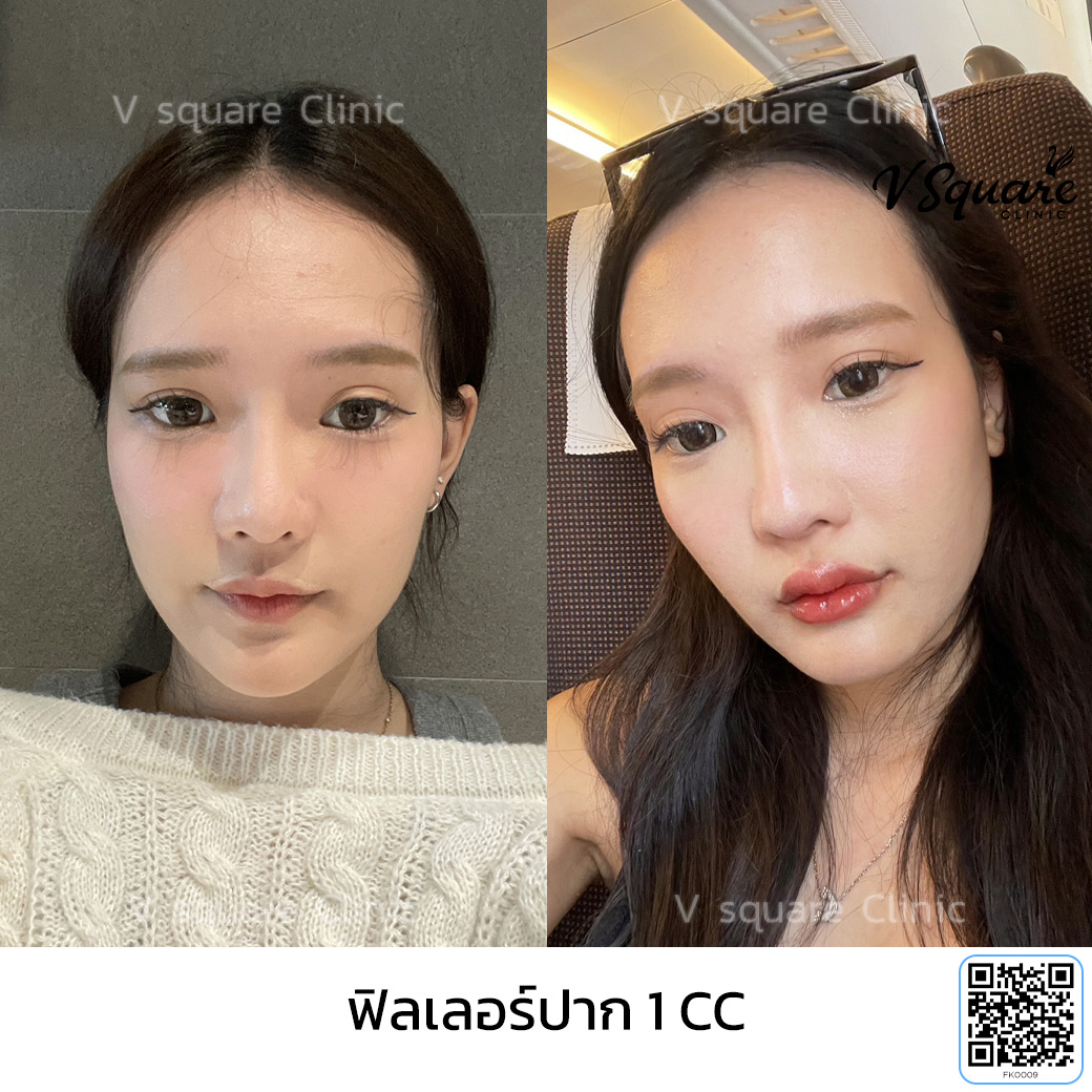 รีวิวฉีดฟิลเลอร์ Restylane Kysse_คุณโมกุล อินฟลู