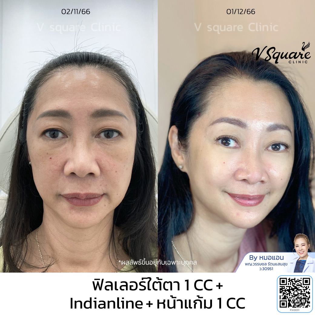 รีวิวฉีดฟิลเลอร์ Restylane_คุณกฤติกา_โดยหมอแอน