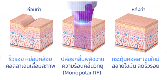 หลักการทำงานของ Thermage FLX