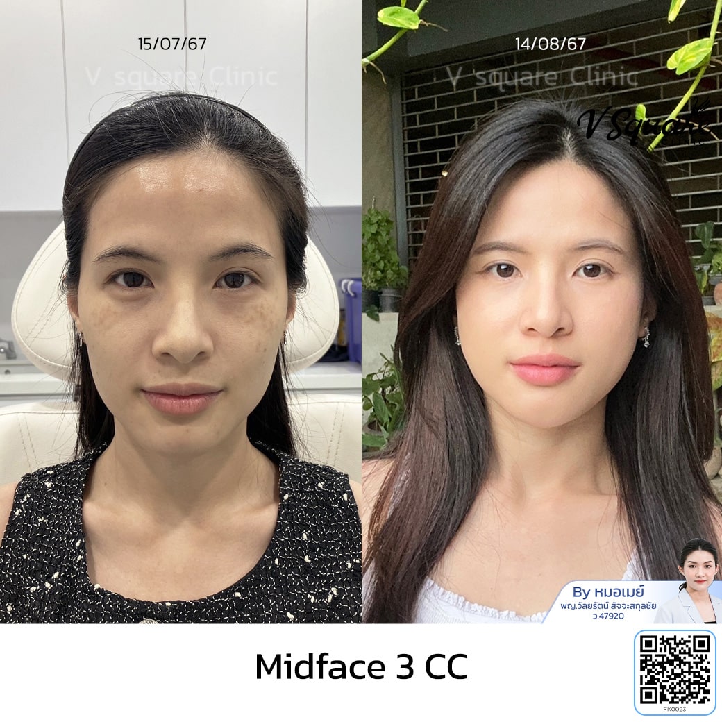 รีวิวฟิลเลอร์แก้มส้ม_คุณขุงขิง_โดยหมอเมย์