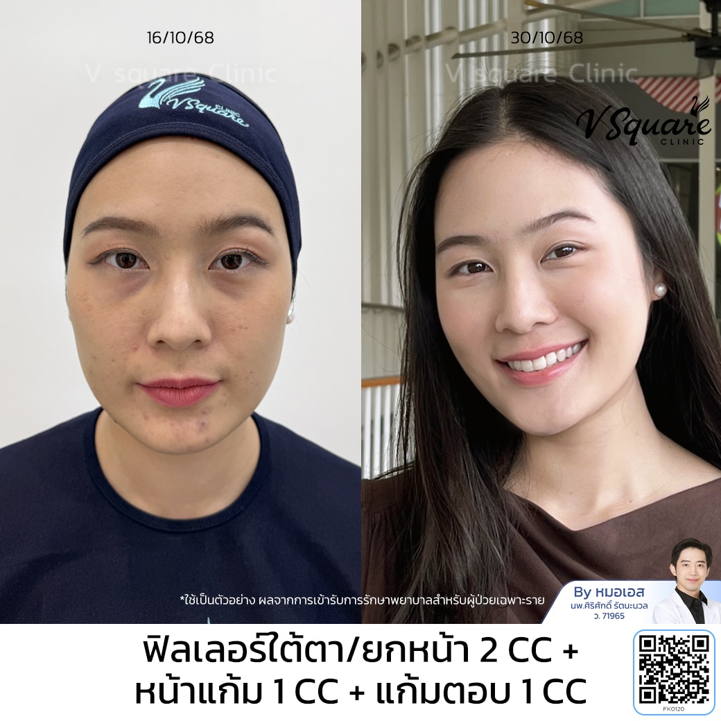 รีวิวฟิลเลอร์แก้มส้ม_คุณฟ้า VSQ_โดยหมอเอส