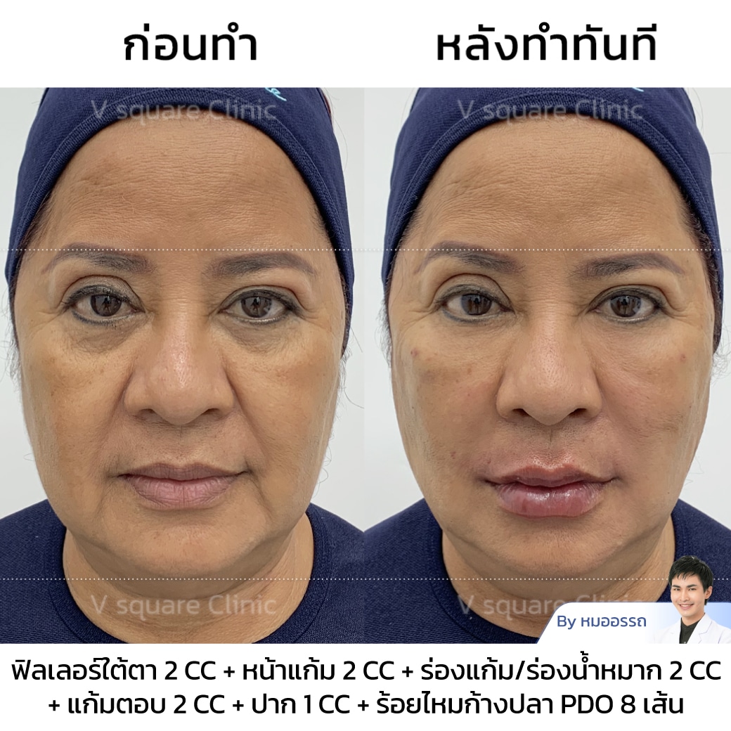 Best Barbed Thread Lift Types in 2026 & Key Differences