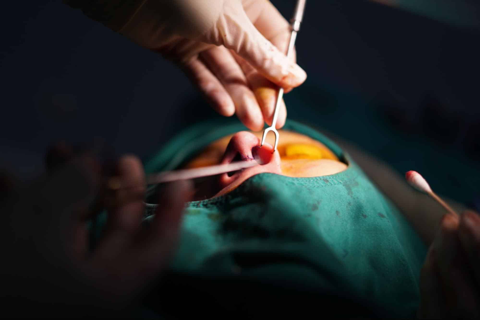 Rhinoplasty Basics: Types, Benefits & What to Know First