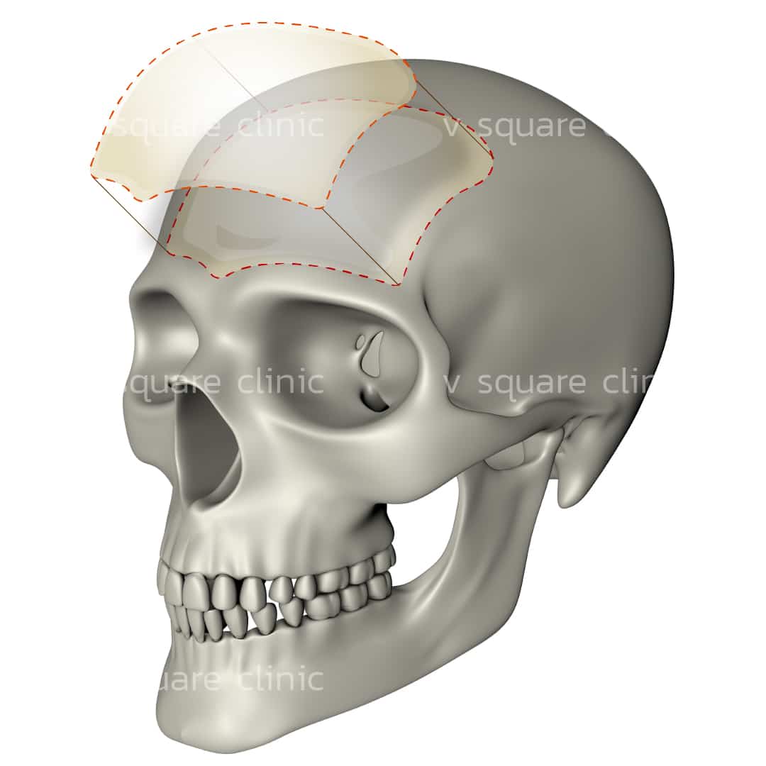 Forehead Filler vs Implants — Which Is the Better Choice