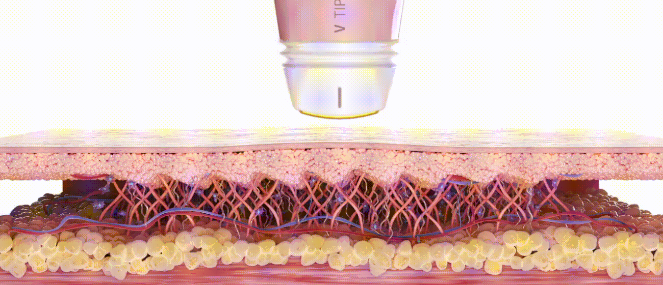 Volnewmer how it works