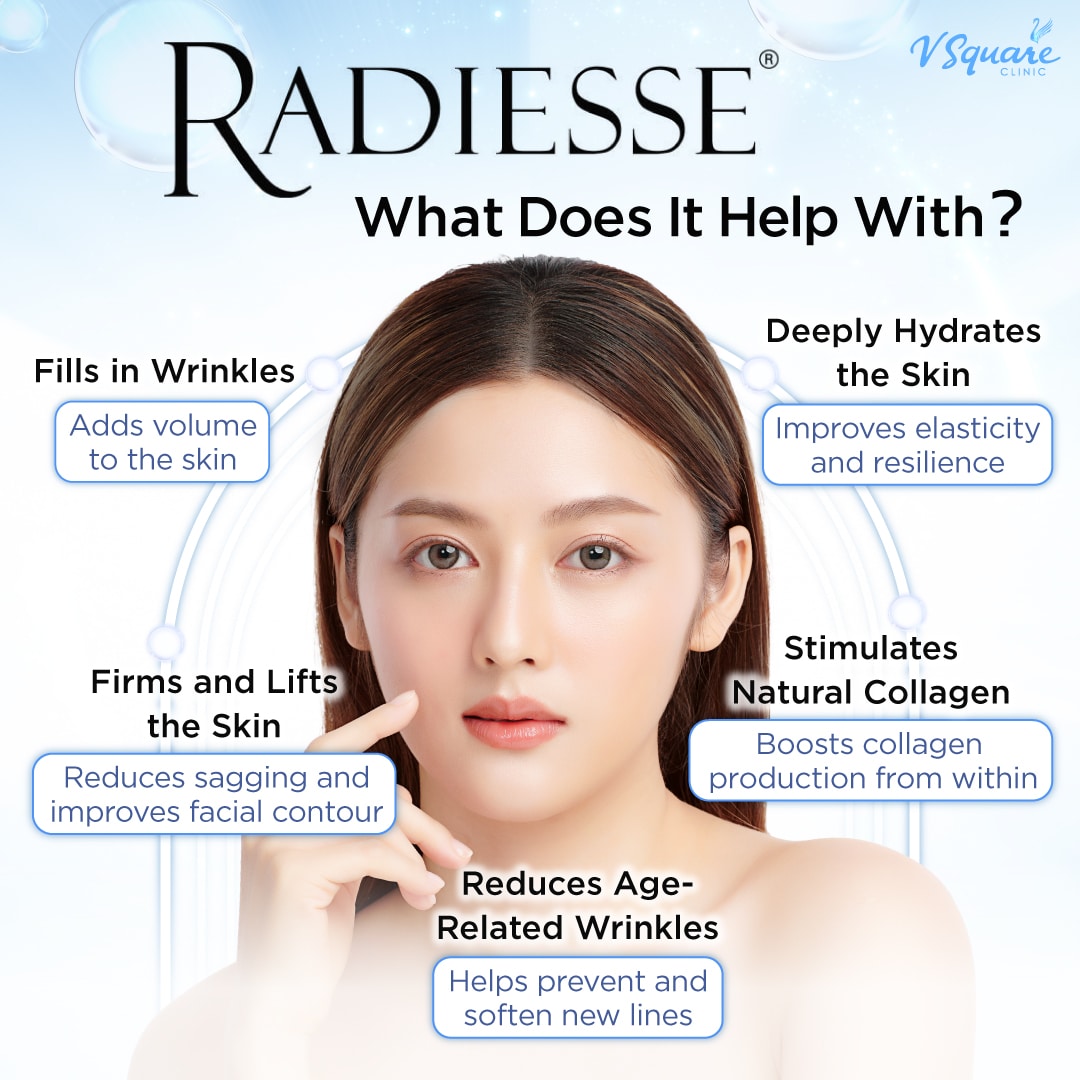 What does Radiesse Filler help with