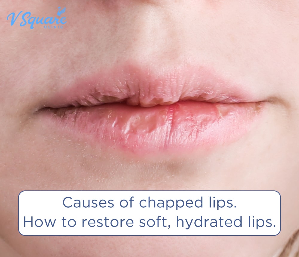 ghk-cu injectable side effects dry lips or chapped lips Chapped Lips: Causes & Ways to Treat Dry, Cracked Lips