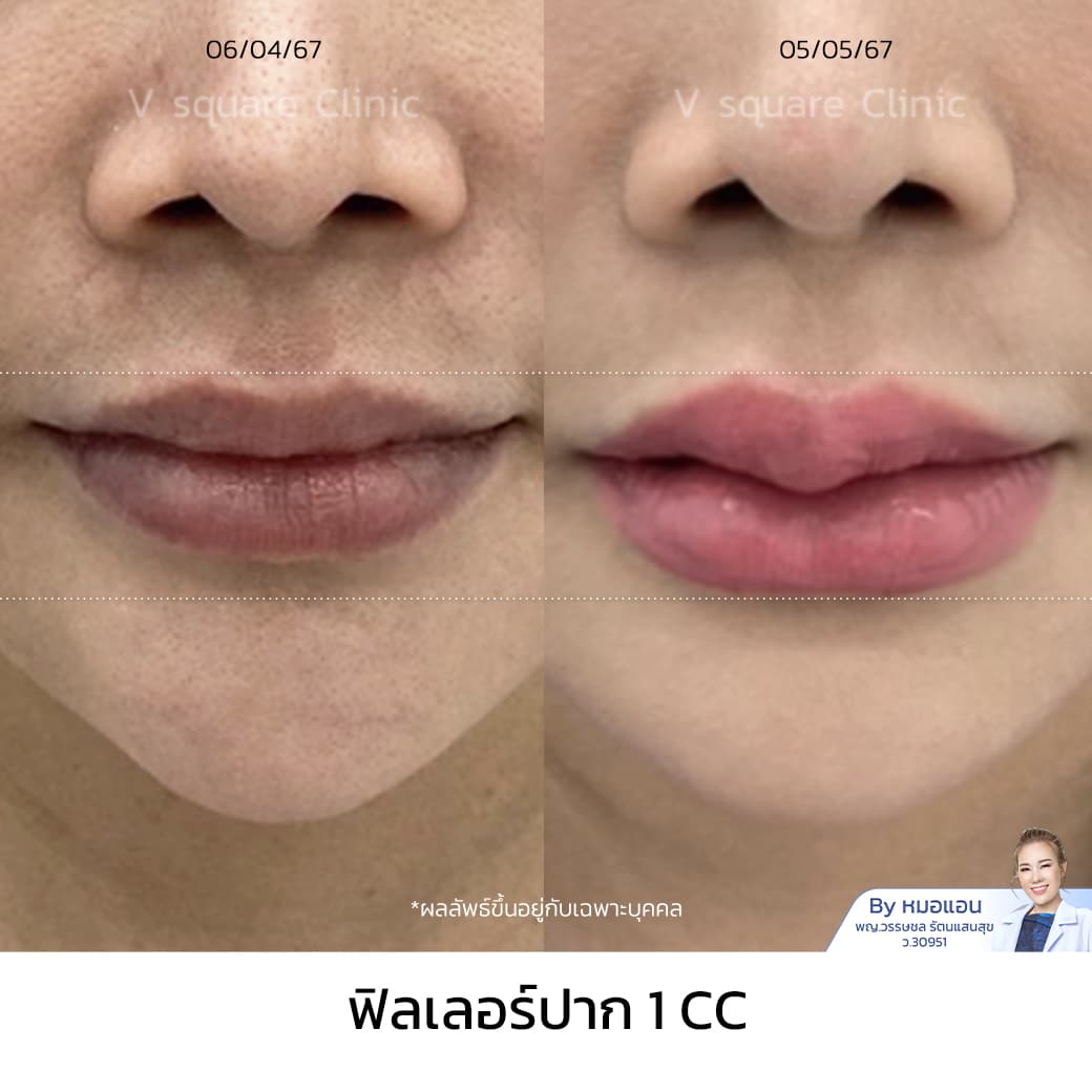 ghk-cu injectable side effects dry lips or chapped lips Chapped Lips: Causes & Ways to Treat Dry, Cracked Lips