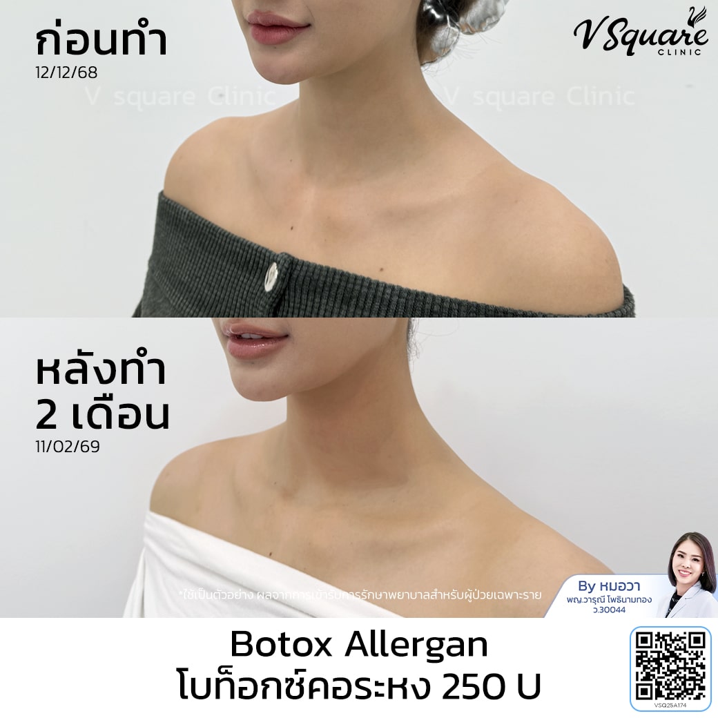 รีวิวโบท็อกคอระหง_คุณเจนิส_โดยหมอวา
