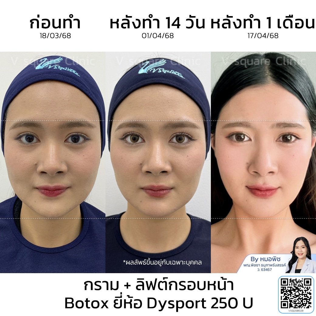 รีวิวโบท็อกช่วยลดกราม ลิฟกรอบหน้า_คุณฟ้า_โดยหมอพิช