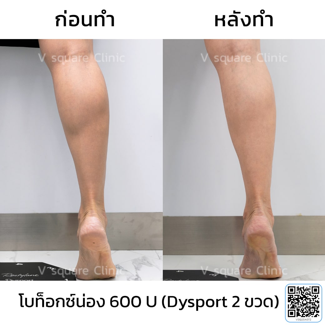 รีวิวโบท็อกช่วยลดน่อง_คุณแจน (โบท็อกซ์น่อง)