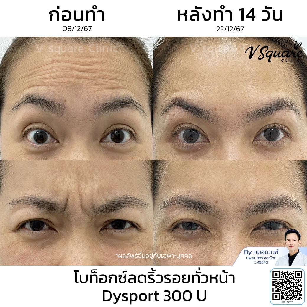 รีวิวโบท็อกช่วยลดริ้วรอยทั่วหน้า_คุณจุฑามาศ_โดยหมอเบนซ์
